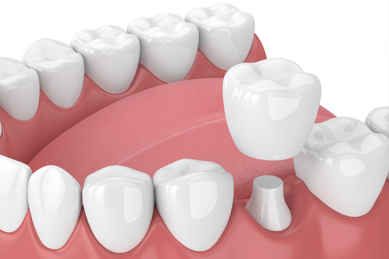 Dental Crowns in Lynchburg